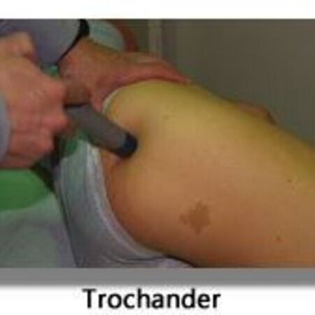 Trochanter