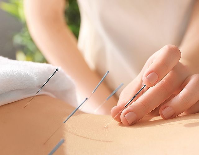 Hand setzt Akupunkturnadel in Haut ein, weitere Nadeln sind bereits gestochen